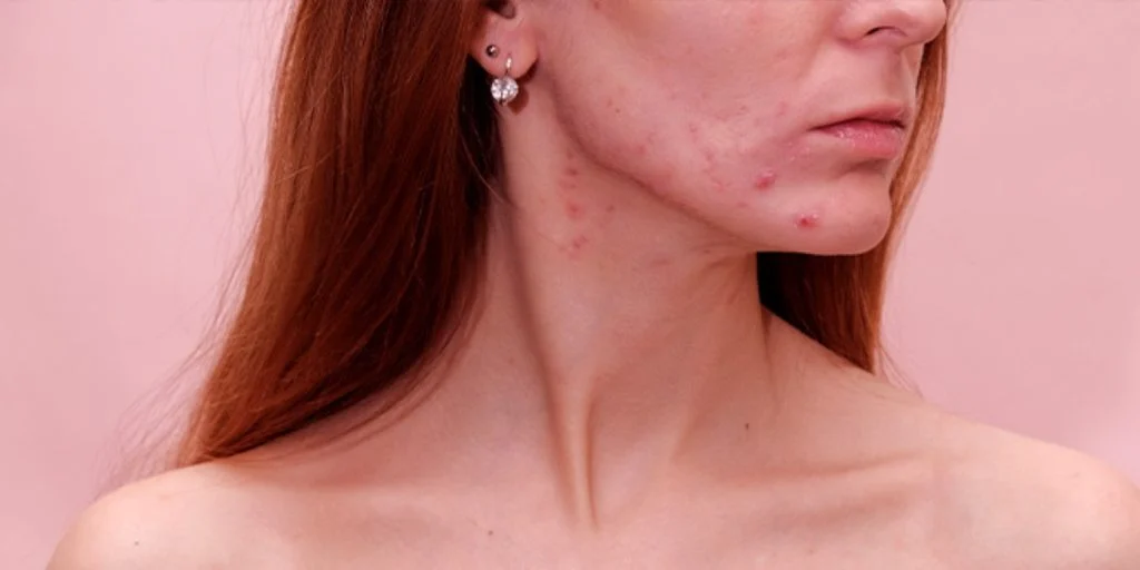 Menstruacija i akne – kako su te dvije stvari povezane?