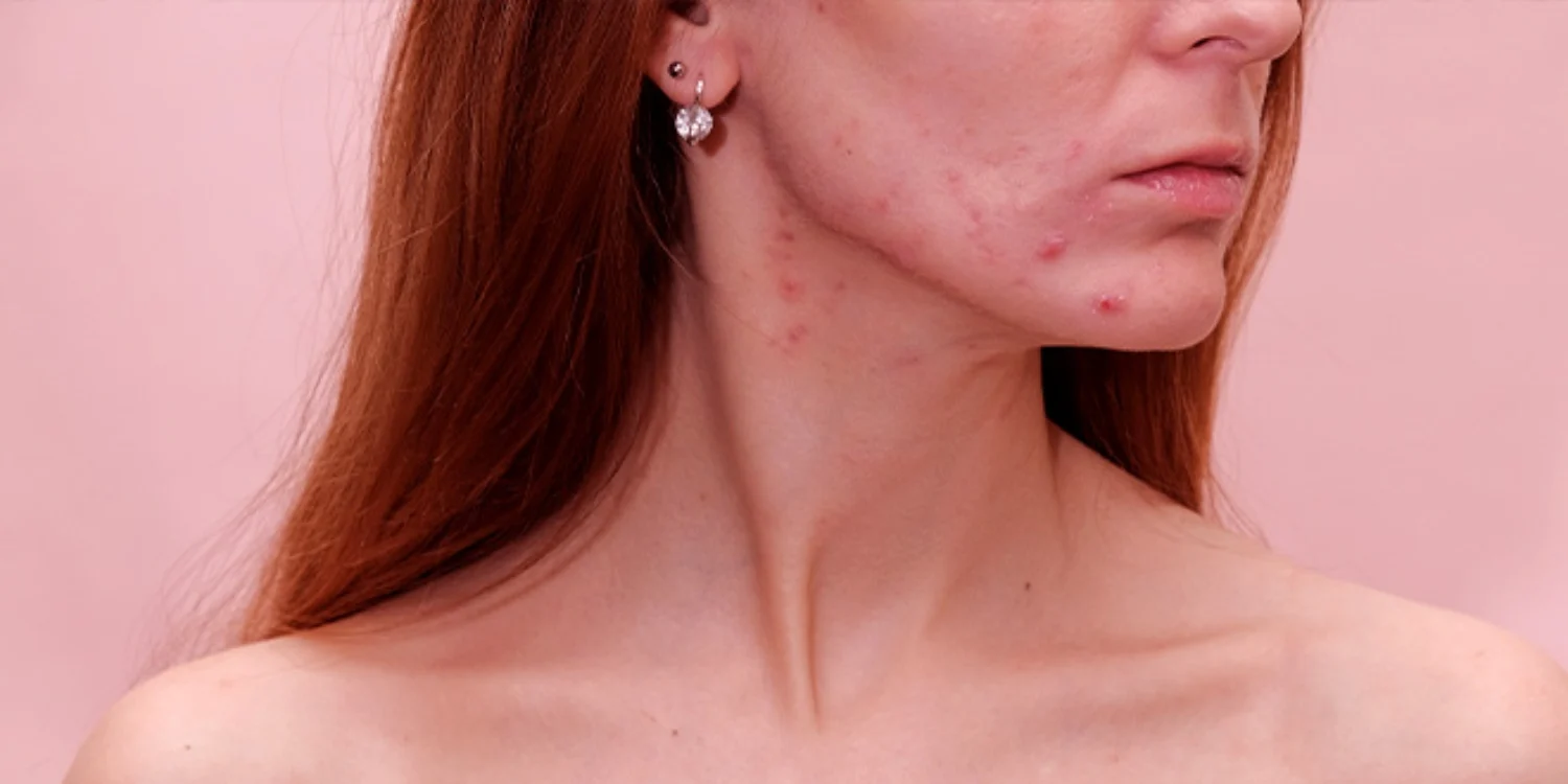 Menstruacija i akne – kako su te dvije stvari povezane?