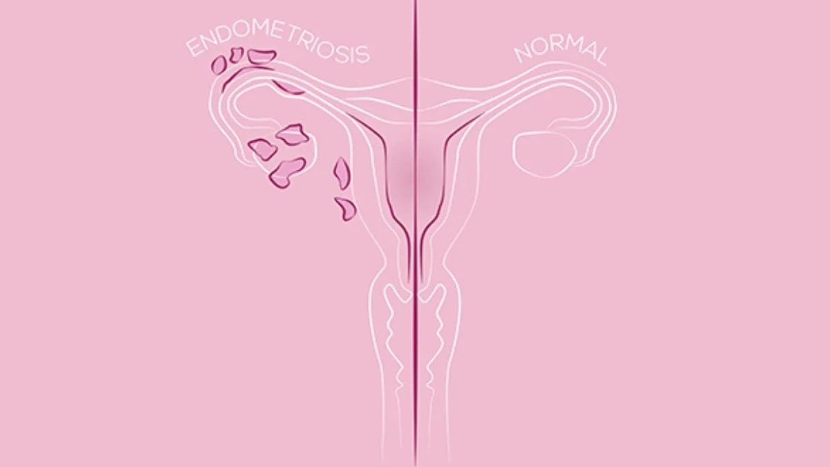 Mjesec osviještenosti o endometriozi: Zašto žene čekaju 8 godina na dijagnozu