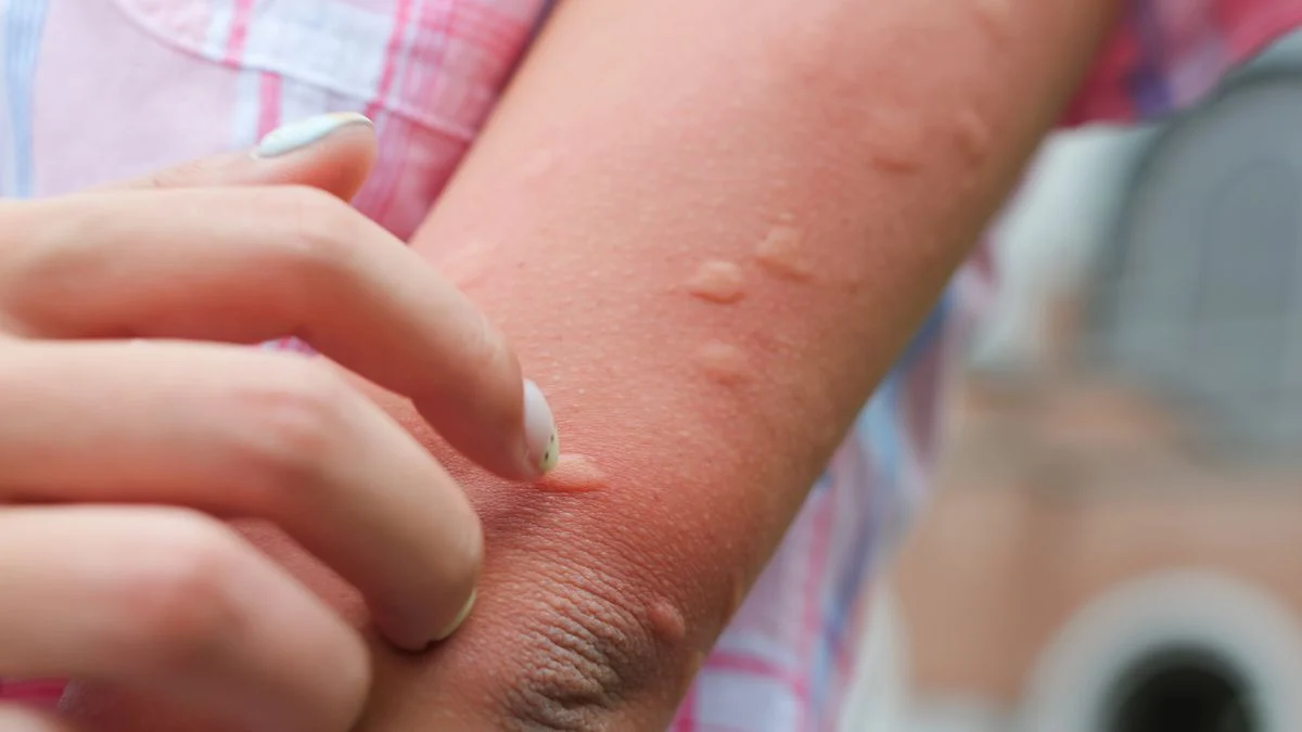 Oprez: u Hrvatsku stigao virus Zapadnog Nila. Što treba znati o uzrocima, simptomima i liječenju?