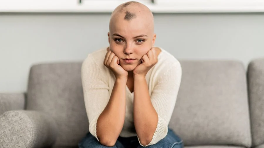 alopecija