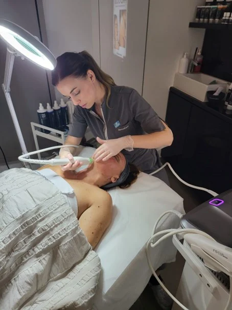 microneedling